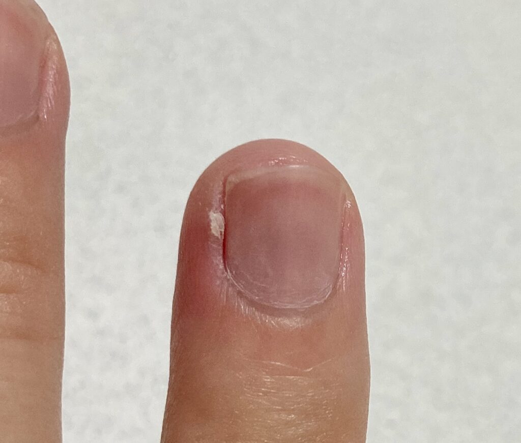 ささくれの正しいケア方法とは?原因・予防・NG習慣まで徹底解説│美容情報サイト Beauty Web(ビューティーウェブ)
